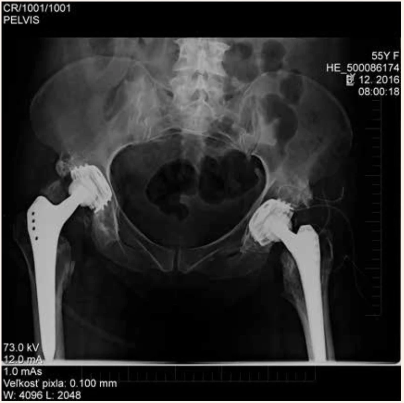 Stav po exstirpácii heterotopických osifikátov ľavého bedrového kĺbu s implantáciou totálnej endoprotézy v jednej dobe
