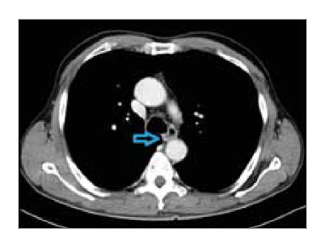 Kontrastní CT snímek zesílení 
stěny jícnu v místě záchytu dlaždicobuněčného
karcinomu (cT1b cN0). CT
provedeno k doplnění diagnostiky
po PET/CT, které tumor nezachytilo.
Nádor označen modrou šipkou.<br>
Fig. 3. Contrast-enhanced CT scan of
the thickening of the esophageal wall
in the location of the squamous cell
carcinoma (cT1b cN0). CT was performed
to complete the diagnosis after
PET/CT, which did not capture the tumor
(tumor marked with blue arrow).