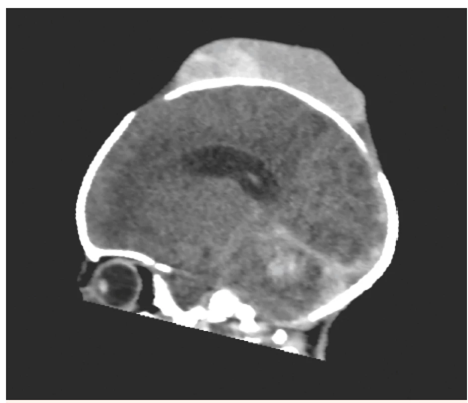 Stejné CT vyšetření jako na obr. č. 3 – nyní v sagitálním
řezu: Je zachycen především objemný kefalhematom.
Hrozící okcipitální konus.<br>
Fig. 4. The same patient as No. 3 – CT scan, sagittal view:
Voluminous cephalhematoma. Oncoming occipital
conus.
