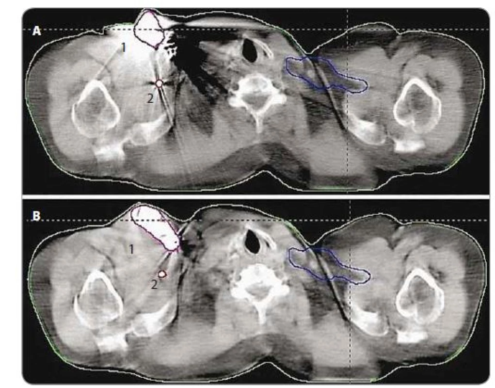 CT scans with (a) and without (b) metal artifacts, where 1 and 2 correspond to the
cardiac device and leads respectively.