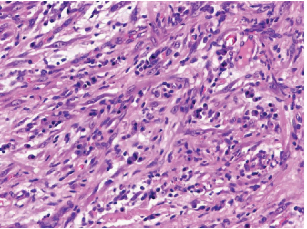 Infl amatorní myofi broblastický tumor.V infl amatorním myofi broblastickém tumoru je, podobně jako v sarkomu z folikulárních dendritických
buněk, intimní vztah nádorových dužnatých vřetenitých buněk s  buňkami
chronického zánětlivého infi ltrátu (HE, 200x).