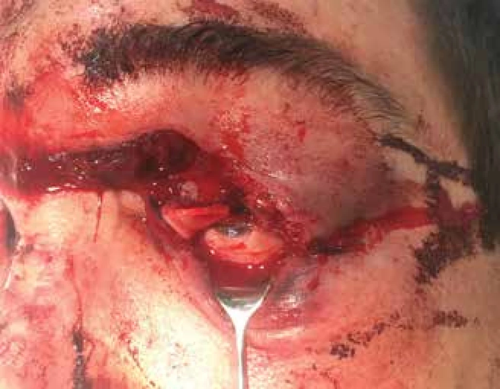 a. Industrial injury by saw. The wound on the upper eyelid is deep enough to cause damage to the musculus levator
palpebrae superioris