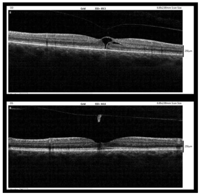 OCT nález pět týdnů po diagnóze MD (10/2017, nahoře
– pravé oko, dole – levé oko)