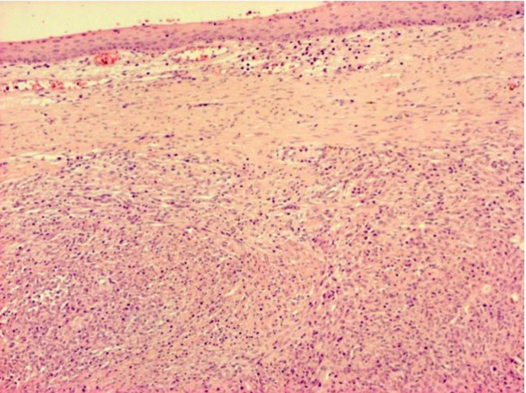 Histology. From the results of the immunohistochemical
staining together with the histopathological findings, the case
was evaluated as low-grade leiomyosarcoma.