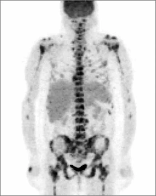 Vyšetrenie zobrazovacími metódami: PET-CT –
skeletálne metastázy. Archív Onkologického
ústavu sv. Alžbety, s.r.o., Bratislava