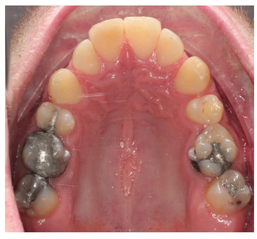b Narrow upper dental arch