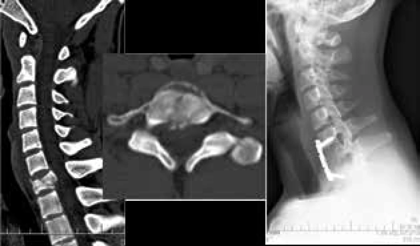 Zlomenina C7 typu A4 na sagitálním a axiálním
CT, kde je patrné rozlomení obratlového těla
s prominencí úlomků za zadní hranu obratlového těla
nativní rentgenový snímek krční páteře zobrazující stav
po resekci rozlomeného obratlového těla, implantaci
radiolucentní expanzibilní náhrady a fixaci C6-Th1
přední krční dlahou.<br>
Fig. 1: Fracture of C7 A4 on sagittal and axial CT, vertebral
body destruction and protrusion of bony chips from
posterior wall into spine canal is demonstrated X-ray
control of cervical spine after resection of fractured
vertebrae with radiolucent vertebral body replacement
and C7-Th1 fixation using anterior cervical plate.