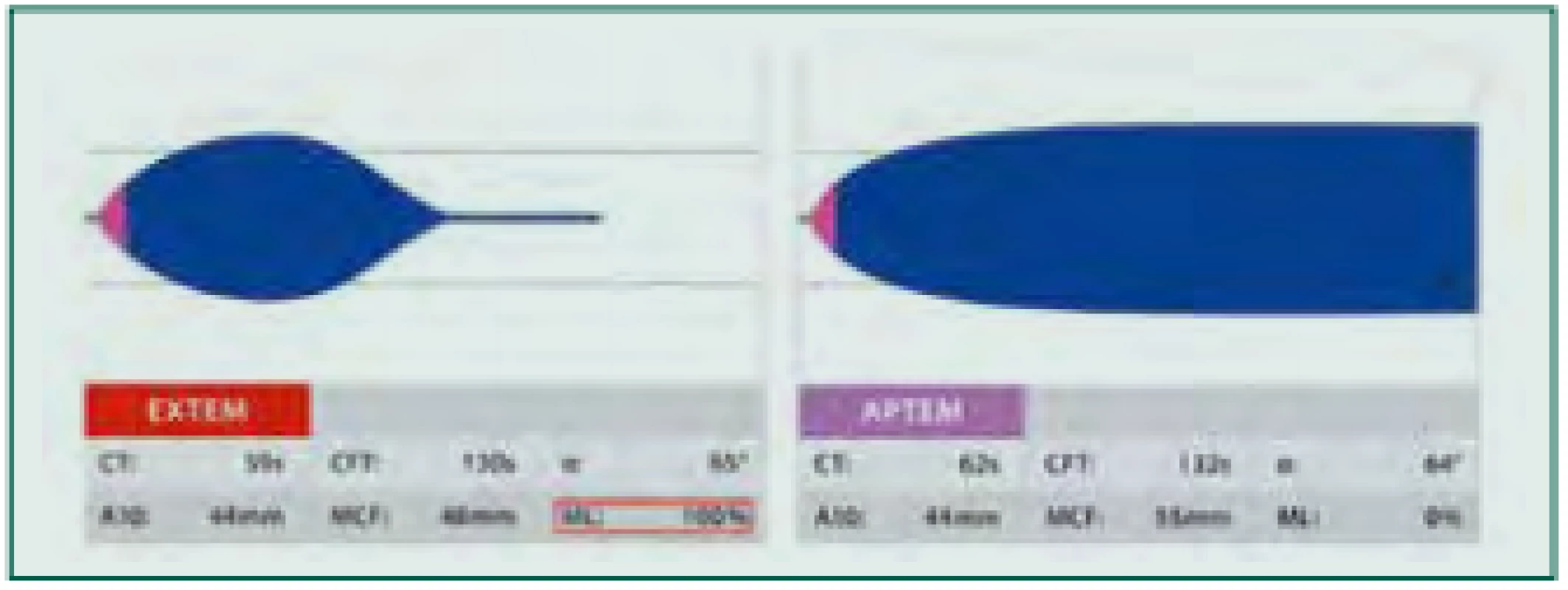 Hyperfibrinolýza: Provedený test EXTEM s patologickým tvarem
křivky a patologickými hodnotami parametrů LI30, LI60 či ML (červený ráme‑
ček, normální hodnoty 0–15 %) může znamenat zvýšenou míru fibrinolýzy.
K ověření je proveden test APTEM s antifibrinolyticky působícím aprotininem.
Při normalizaci tvaru křivky a parametrů lýzy přichází v úvahu terapie anti‑
fibrinolytiky, např. kyselinou tranexamovou.