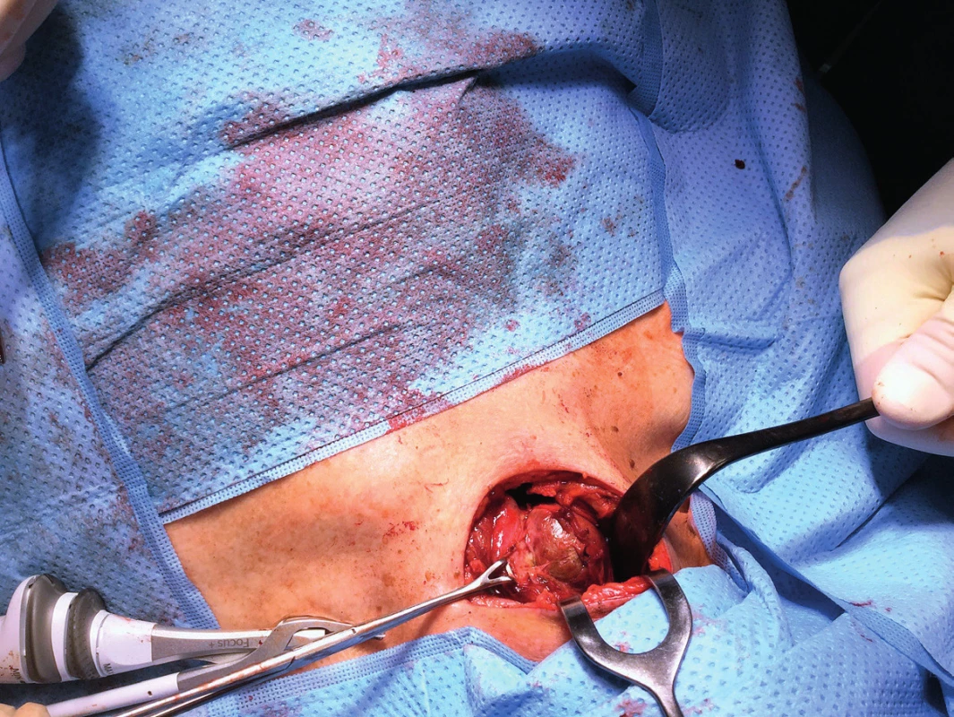 Peroperační nález: prokrvácený nádor – adenom příštítného tělíska –
v těsném kontaktu se štítnou žlázou