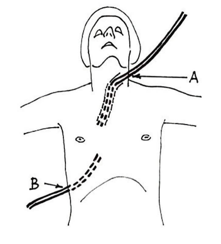 Schéma transtorakální laváže mediastina
(A-proplachový dren, B-odvodní hrudní dren).