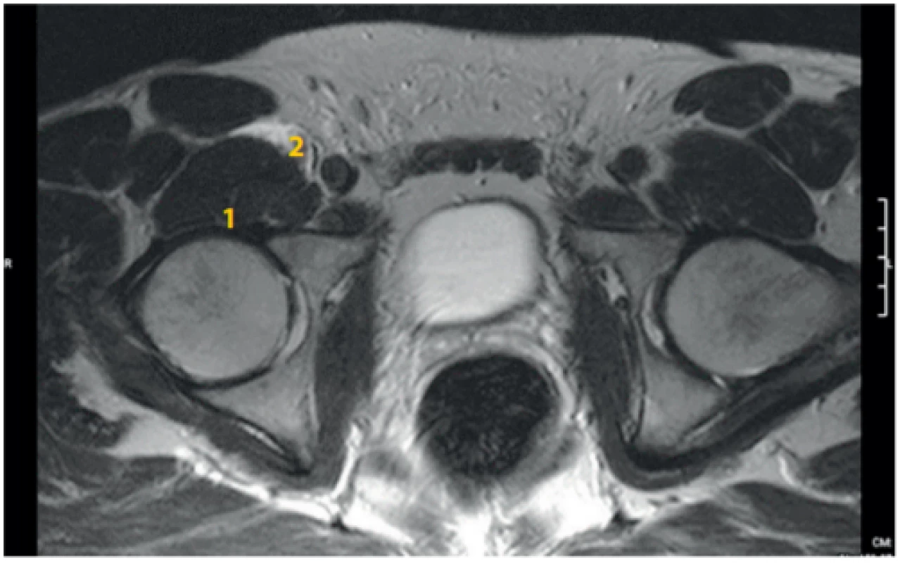 MRI dutiny břišní u stejného dobrovolníka jako u obr. 8, vertikální
řez, po podání 20 ml fyziologického roztoku cestou psoas compartment blok
ve výši L2–3 vlevo a 20 ml fyziologického roztoku cestou infrainguinálního
femorálního bloku (3 in 1) vpravo: horizontální řez pánví v úrovni kyčelního
kloubu. 1. m. ilopsoas, 2. přítomnost tekutiny v iliopsoatické fascii po aplikaci cestou infrainguinálního podání vpravo (náplň byla identifikovatelná
do úrovně S4). Na levé straně již není patrná náplň z bloku z oblasti psoas
kompartmentu L2–3