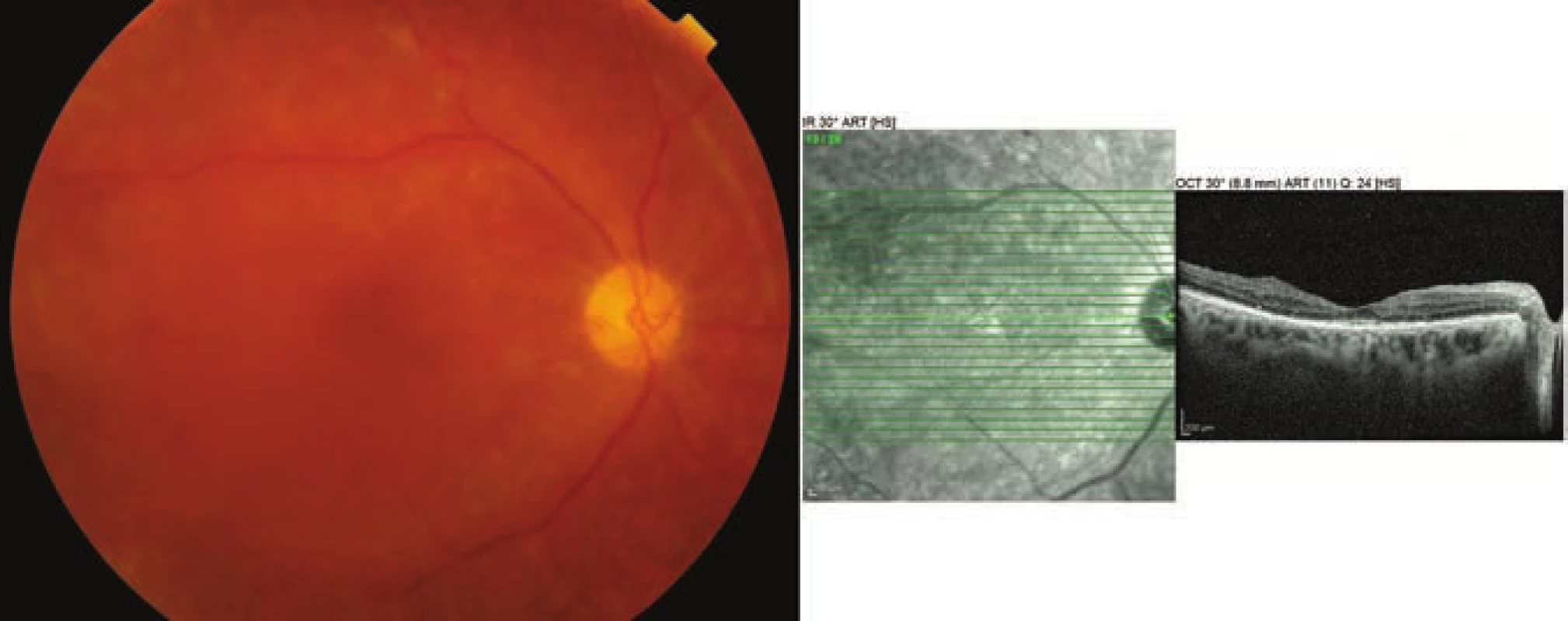 Fotografie očního pozadí a OCT vyšetření pravého oka 11 měsíců po operaci