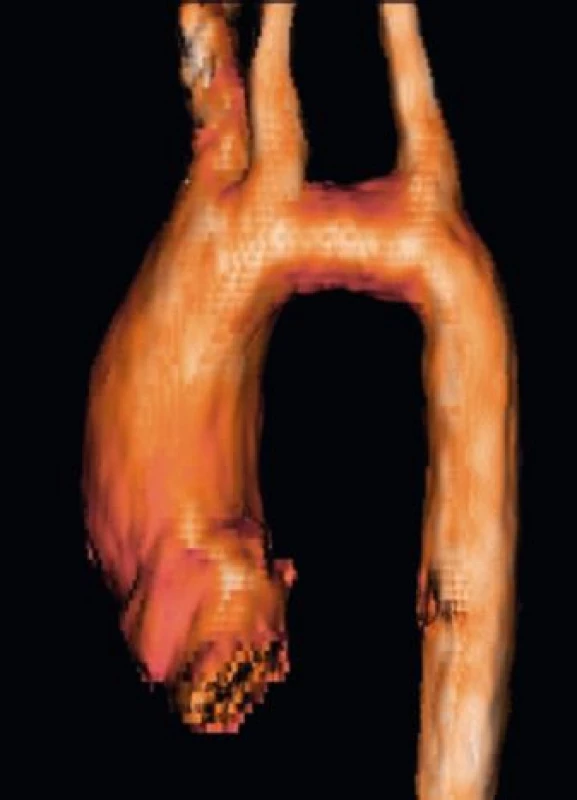 Elongace transverzálního aortálního oblouku – 3D rekonstrukce
z vyšetření magnetickou rezonancí (archiv
autorů).<br>
Fig. 5. MRI reconstruction image demonstrating elongated
transverse aortic arch (authors archive).