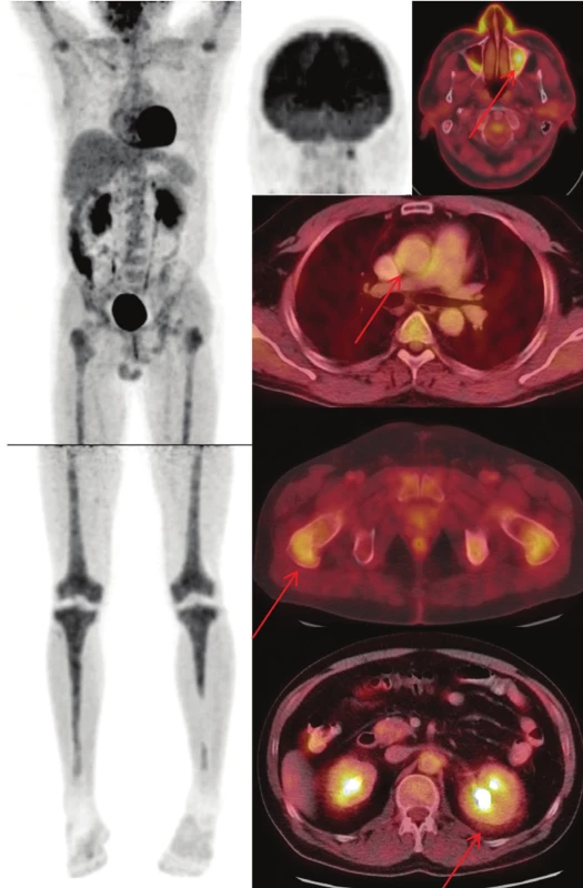 (nahoře) Sumarizace nálezů
  <sup>18</sup>F-FDG PET/CT vyšetření u pacienta
č. 2. Černobílé MIP projekce ukazují
rozsah snímání, odráží i rozsah kostního
postižení. Fúzované obrazy pak ukazují
detaily paranasálního, kardiovaskulárního,
kostního, retroperitoneálního
postižení.