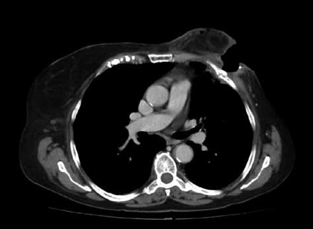 CT hrudníku – patrná usurace žeber a  pleurální
adheze<br>
Fig. 1: CT chest scan – noticeable ussurated ribs and pleural adhesions