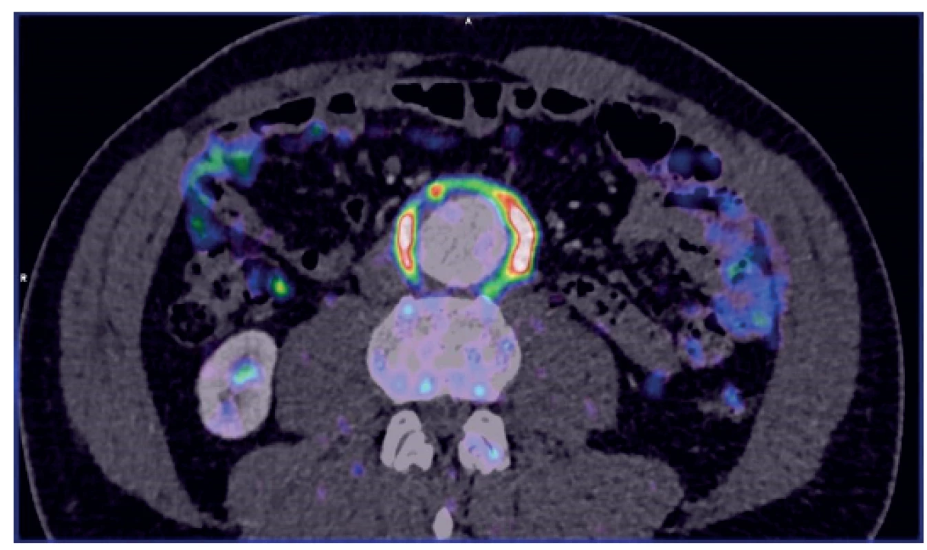PET/CT – small mycotic AAA