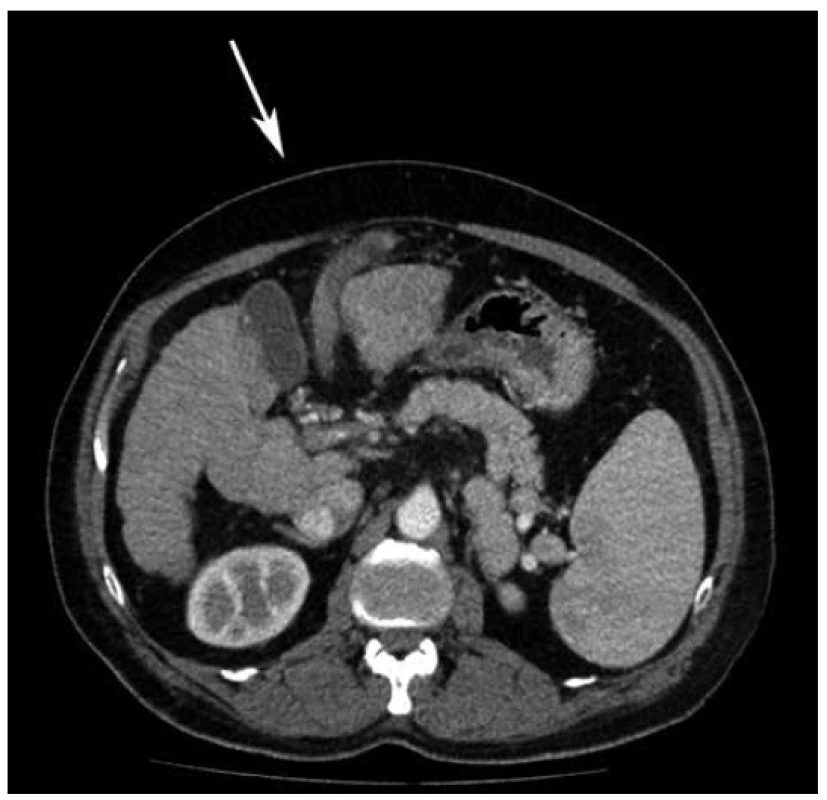 CT abdomen – thrombophlebitis of umbilical vein