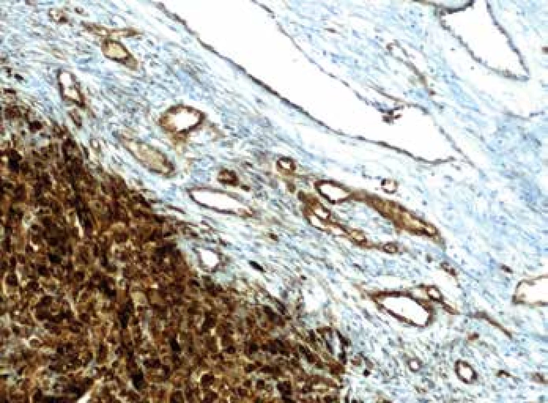 Imunohistochemický průkaz protilátky anti-Nestin v novotvořených
kapilárách na periferii tumoru (zvětšení 200x).