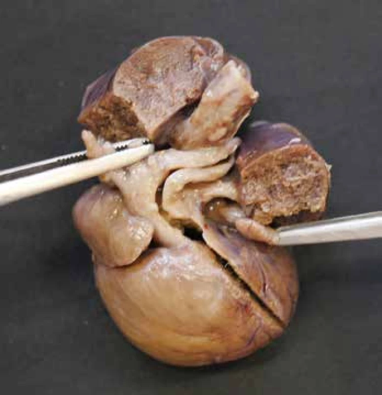 Společný arteriální trunkus s odstupem arteriálních větví pro horní
polovinu těla a patrnou levostrannou plicní arterií.
