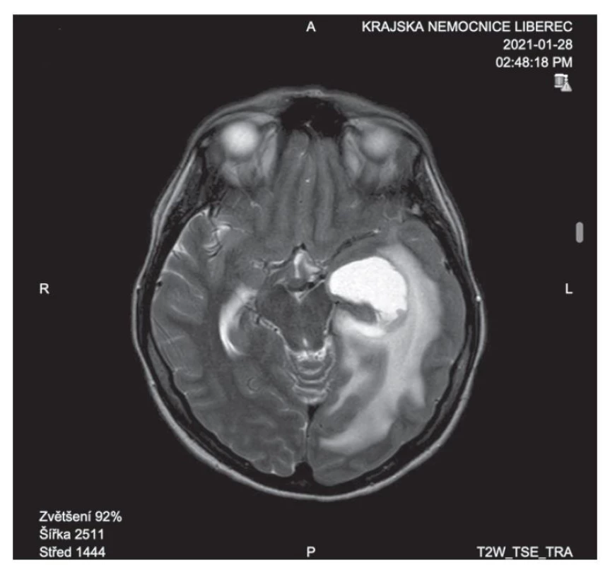 Kontrastní magnetická rezonance mozku.<br>
Fig. 2. Contrasting magnetic resonance imaging of the brain.
