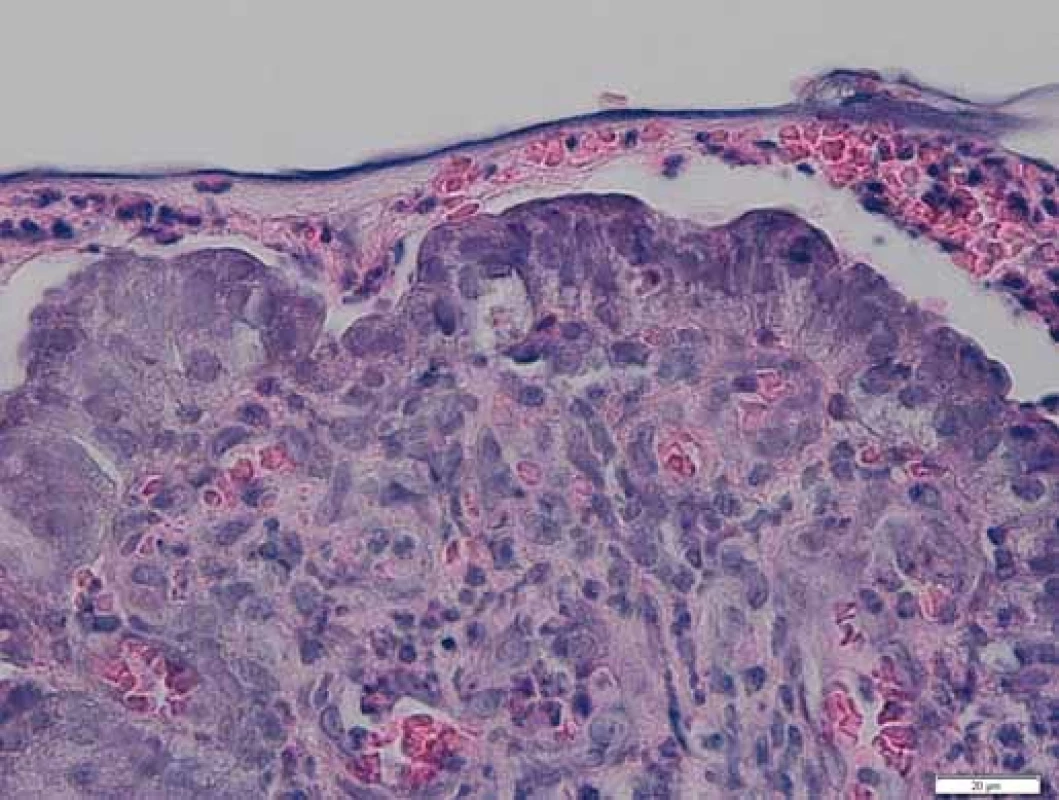 Histologie – polypózní adenomatózní léze s lehkou
až střední dysplazií povrchového epitelu. Zvětšeno 400×.