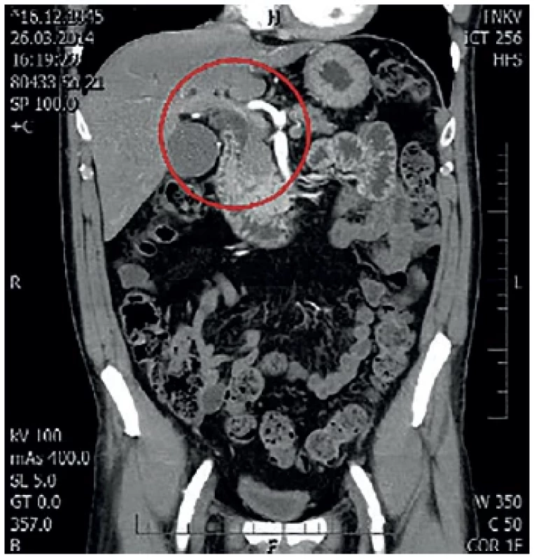 MDCT s nálezem double duct sign
V červeném kruhu dilatace hepatocholedochu. <br> 
Fig. 2: MDCT with double duct sign
Dilatation of the common bile duct is captured in the red circle.