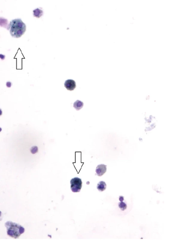 Nález siderofágů v bronchoalveolární tekutině, barvení May Grünwald Giemsa, zvětšení 100× (se svolením Ústavu patologie, FN Brno, MUDr. V. Kubeš)