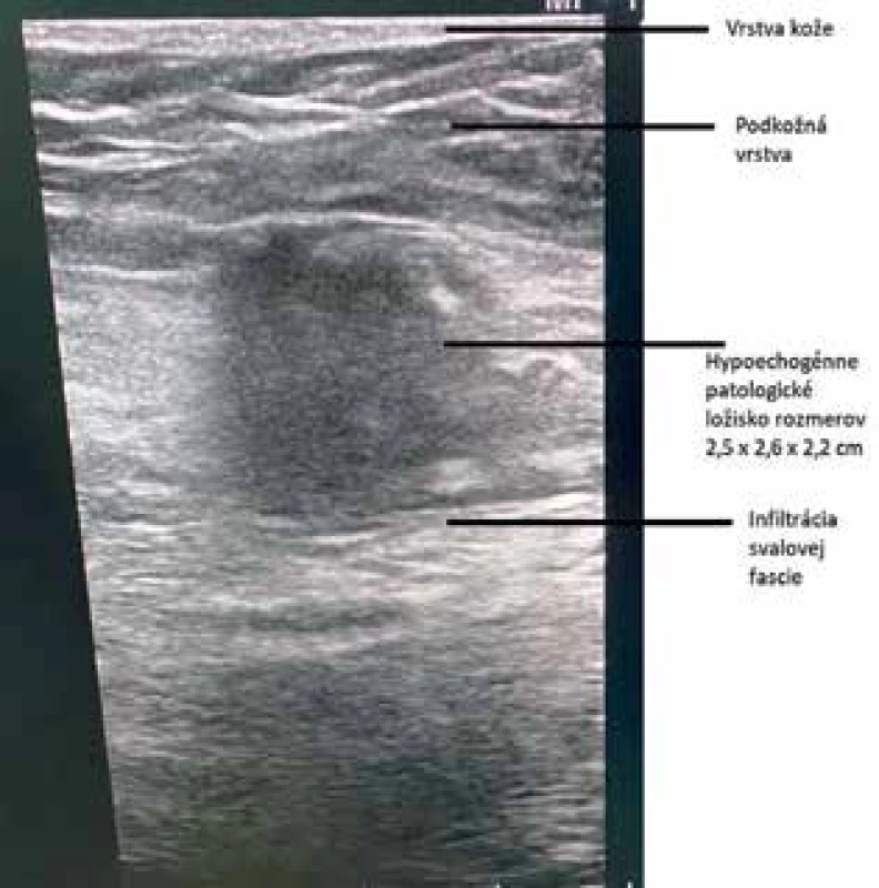 USG brušnej steny: neostro ohraničené hypoechogénne ložisko rozmerov 2,5×2,6×2,2 cm v úrovni svalovej 
vrstvy v pravom hypogastriu<br>
Fig. 1: Abdominal wall US: hypoechogenic lesion 
2,5×2,6×2,2 cm infiltrating the muscular layer