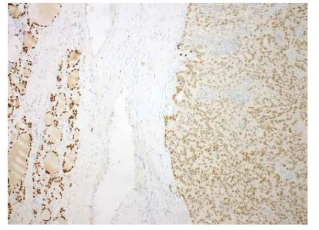 Imunohistochemický průkaz slabé exprese TTF1 (vpravo) ve srovnání
s normálními folikulárními buňkami (vlevo); (zvětšení 100x).