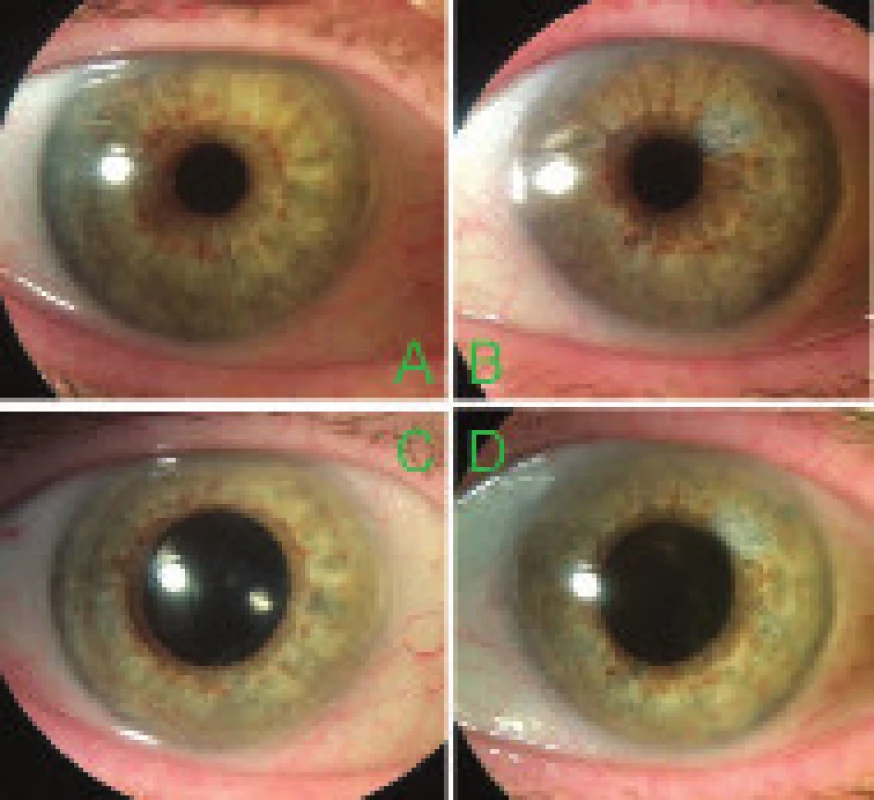 Pseudophakia – natively (A, B) and in artificial
mydriasis (C, D)