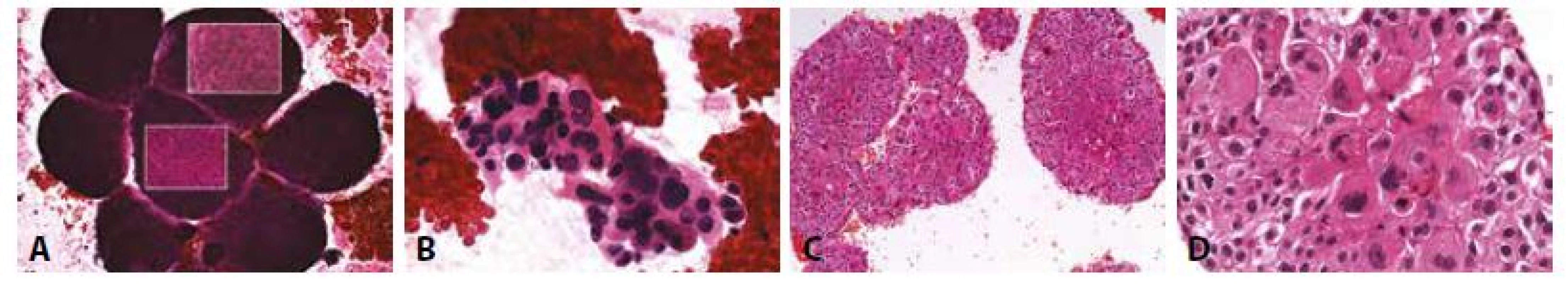 Příklady nejběžnějších karcinóz coelomových dutin: Muž 69 let. Karcinomatózní perikarditis. Spinocelulární karcinom plíce.