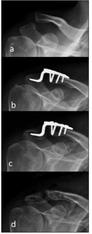 Muž, 58 let, AC luxace typu Rockwood III po pádu při jízdě na cyklistickém kole; a) úrazové snímky, b) stav po jednom měsíci po operaci a po stabilizaci hákovou dlahou v anatomickém postavení v AC skloubení, c) stav ve třech měsících po operaci: zachycena tlaková osteolýza akromia, d) výsledný léčebný stav v šesti měsících po operaci zachycující artrotické změny v AC skloubení