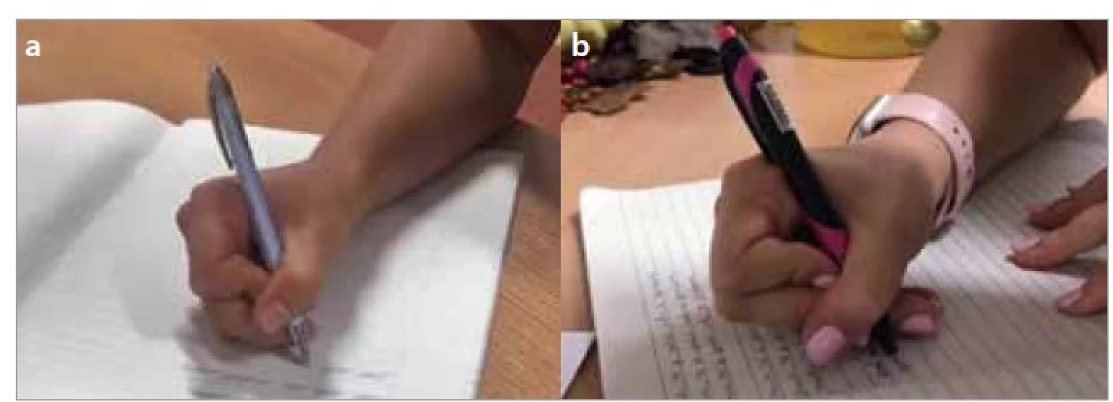 a,b. Boční palcový úchop s palcem přes ukazovák – a) tříprstý, b) čtyřprstý.<br>
Fig. 5a,b. Lateral thumb wrap grip – a) thumb wrap tripod grip, b) thumb wrap
quadruped grip.