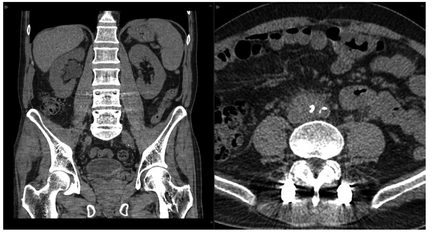 Iniciální nativní CT vyšetření ledvin (v koronární a transverzální rovině) potvrzující dilataci dutého systému pravé ledviny, jejíž příčinou je patologická
tkáň v retroperitoneu působící obstrukci pravého močovodu