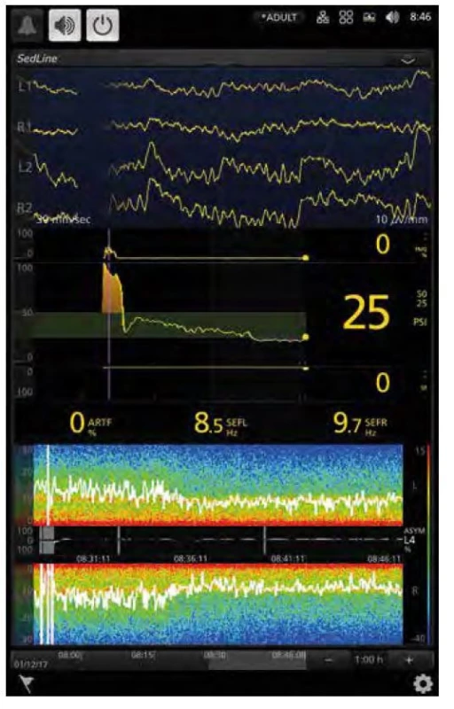 Displej monitoru SedLine: v horní části jsou čtyři svody EEG z čela,
úsek mezi dvěma tečkovanými svislými čarami odpovídá jedné sekundě.
Svislá fialová čára značí úvod do anestezie. Pod EEG je zobrazena EMG
aktivita 0 % a její trend v čase (na počátku je viditelné zvýšení EMG aktivity
po podání sufentanilu), index hloubky anestezie PSI (Patient State Index)
většinu doby v doporučeném rozmezí 25–50, SR (Suppression Ratio) 0
a jeho trend. Délky trendů lze nastavit. Níže je podíl artefaktů (ARTF %), SEFL
a SEFR jsou hodnoty Spectral Edge Frequency Left a Right, 8,5, resp. 9,7 Hz.
Tyto dvě hodnoty znamenají frekvenci, pod níž je 95 % výkonu signálu EEG.
V dolní části je spektrální analýza EEG (viz další článek) po dobu 20 minut