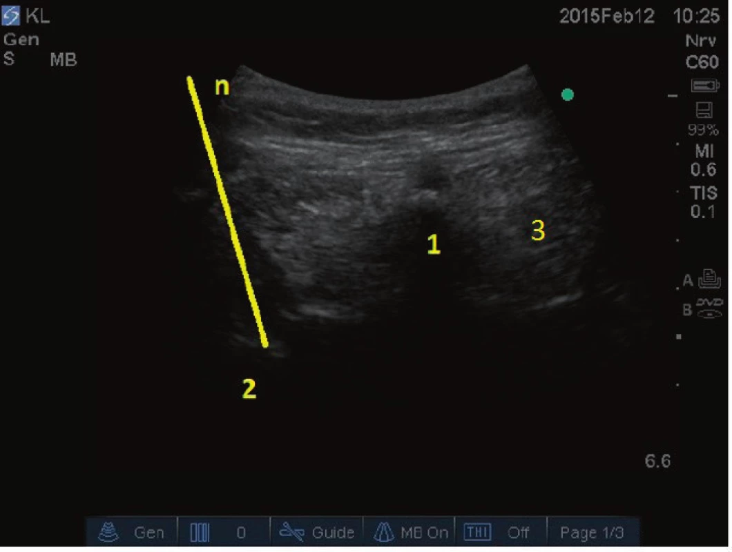 Anatomie pro blokádu ramus medialis (inervace
facetového kloubu) v bederní oblasti. 1 – obratlový trn, 2 –
příčný výběžek obratle, 3 – paravertebrální svaly, n – jehla