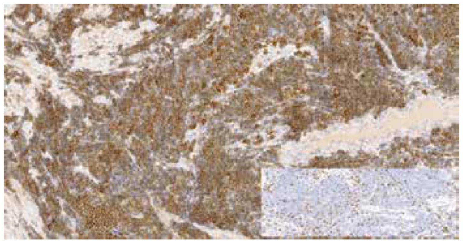 Imunohistochemický průkaz CD20 pozitivních buněk MCL, v pravém
dolním rohu vložen obrázek imunohistochemického průkazu CD3 – reaktivní
T-lymfocyty (zvětšeno 200x).