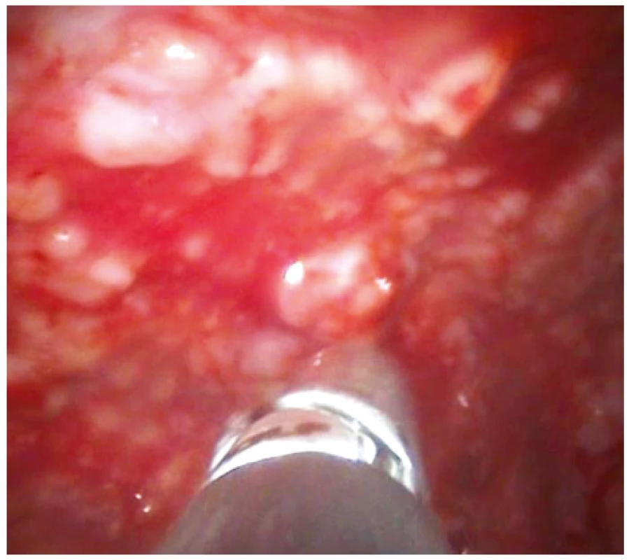 Pleuroskopický obraz stejného pacienta zobrazující
masivní postižení parietální pleury nodulárním procesem,
v tomto případě lymfomem pleury. Patrny bioptické kleště při
odběru vzorku na histologické vyšetření.