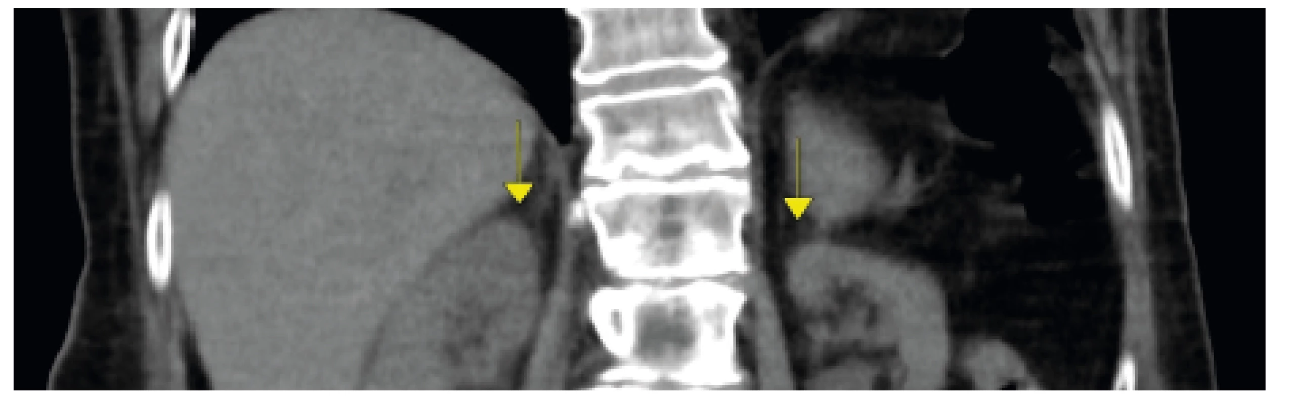 CT břicha, zobrazena atrofie nadledvin, vedlejší nález
atrofický pankreas. Zdroj: Radiologická klinika FN Brno