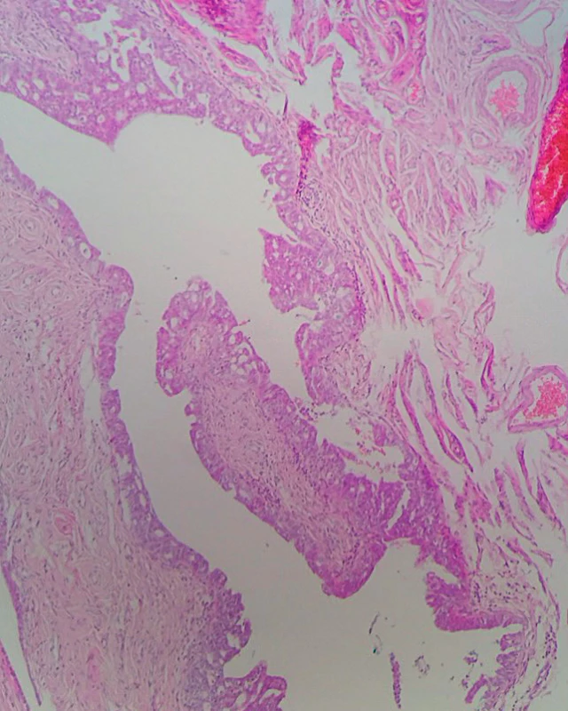 Fimbriae tubae uterinae so seróznym tubálnym intraepiteliálnym karcinómom (STIC); prítomná je stratifikácia jadier a cytologické atypie