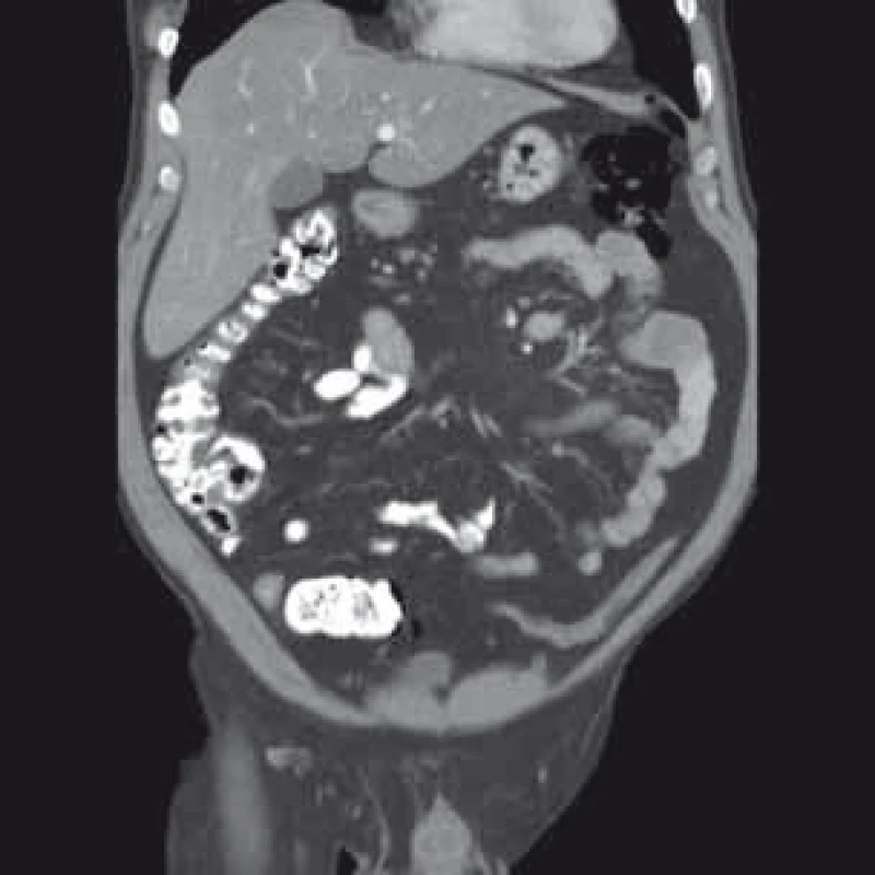 Kontrastní CT vyšetření břicha – koronární řez.