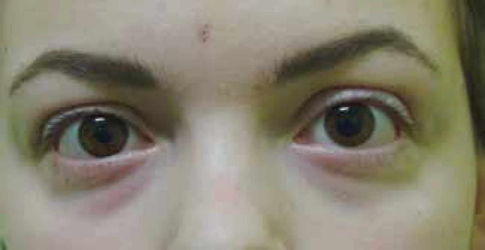 Mydriasis in left eye more pronounced in dark conditions