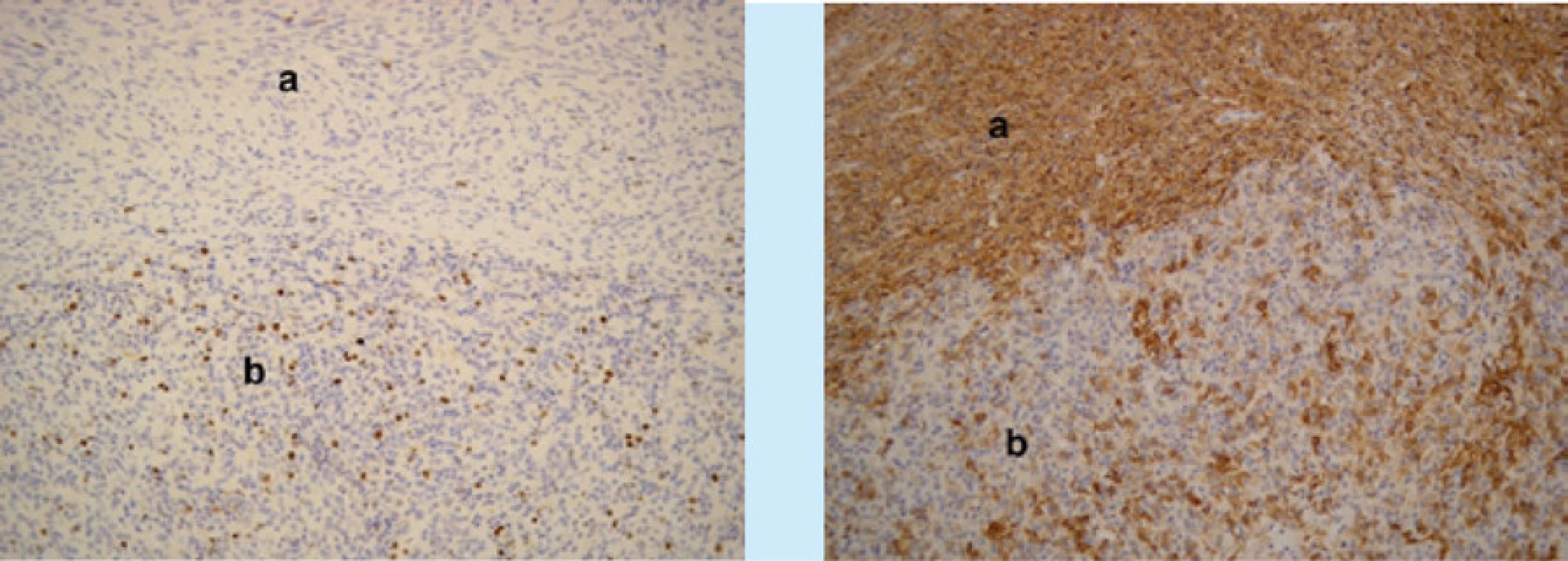 Mikroskopické obrazy stromálního tumoru nejistého maligního potenciálu (Stromal Tumor of Uncertain Malignant Potential, STUMP) včetně imunohistochemického hodnocení. Vlevo (zvětšení 40×, barvení hematoxylin-eozin)
lobulárně uspořádané nádorové ložisko (a), obdané silným vazivovým pouzdrem (b). Vpravo (zvětšení 200×, desmin)
pozitivní imunohistochemická reakce v obou typech nádorových elementů<br>
Fig. 3. Microscopic images of STUMP, including immunohistochemical evaluation. On the left (magnification 40 ×,
hematoxylin-eosin staining) lobularly arranged tumor foci (a), endowed with a strong fibrous sheath (b). On the right
(magnification 200 ×, desmin) positive immunohistochemical reaction in both types of tumor elements