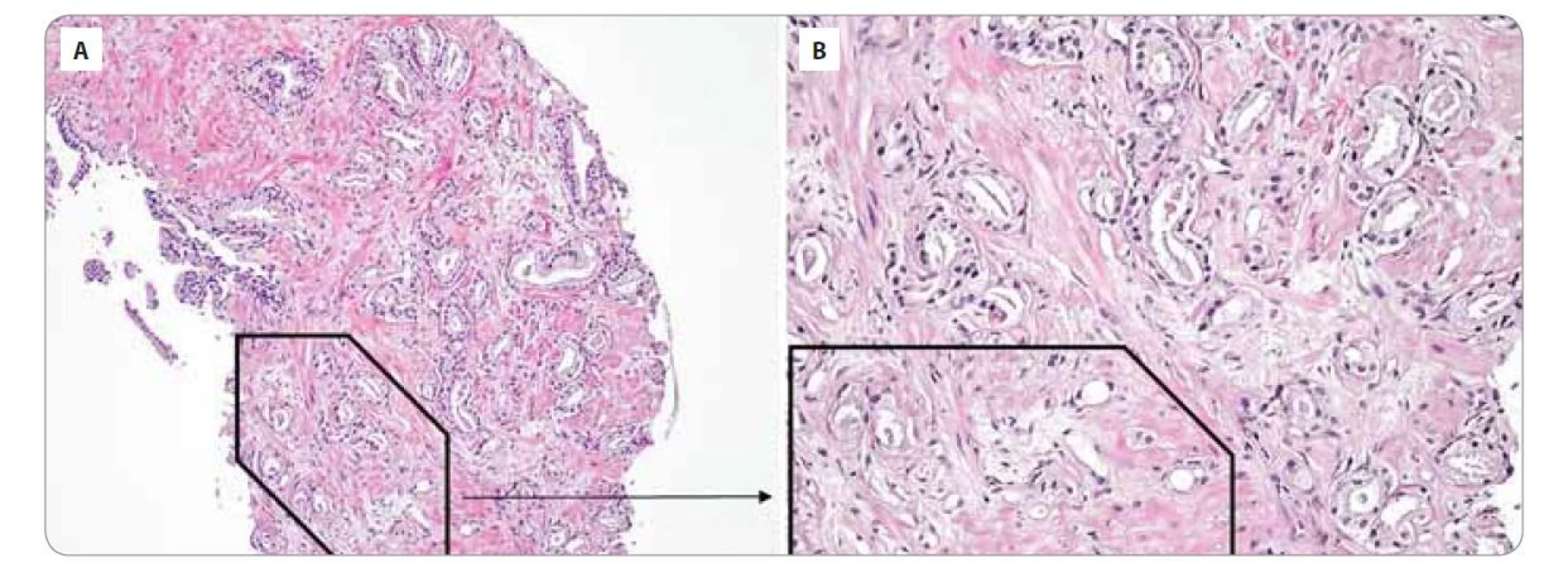 Histologické vyšetření prostaty se semennými váčky prokazující přítomnost acinárního adenokarcinomu prostaty.<br>
Acinární adenokarcinom prostaty, Gleason skóre 7 (3 + 4), grade group 2: převažují izolované nádorové žlázky variabilní velikosti
(Gleason pattern 3) a špatně formované až naznačeně fúzující žlázky (Gleason pattern 4 – černý rámeček). A) Zvětšení 100x; B) zvětšení
200x.
