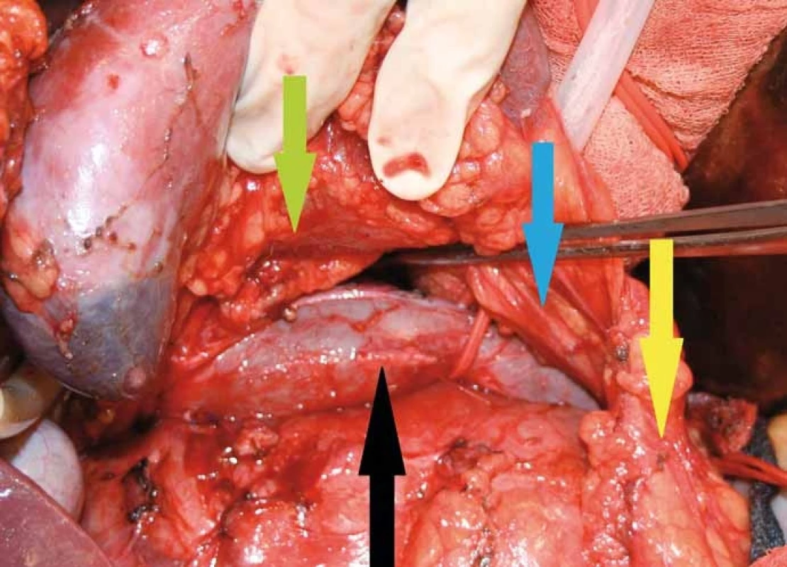 Na snímku je patrná pravá ledvina odpreparovaná od tumoru, je vidět cévní svazek arteria renalis jdoucí retrokaválně (zelená šipka), rovněž i aberantní cévní svazek pro dolní pól ledviny jdoucí prekaválně (modrá šipka). Samotný tumor se zatím nachází ve své mediální porci za dolní dutou žilou (černá šipka). Ureter je označený žlutou šipkou.