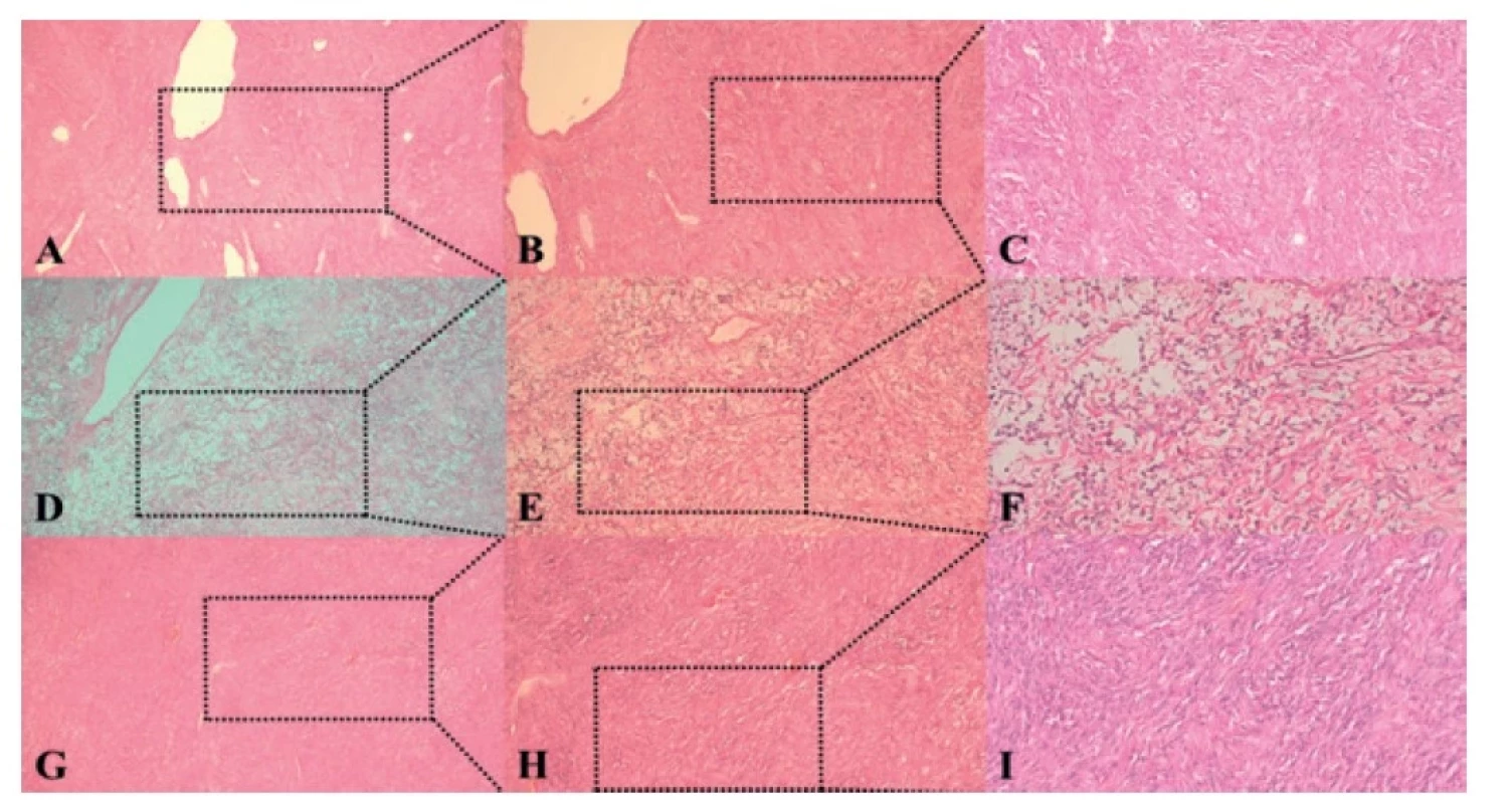 Histologické nálezy tumorov jednotlivých pacientov<br>
Fig. 4: Histological findings of tumors of individual patients