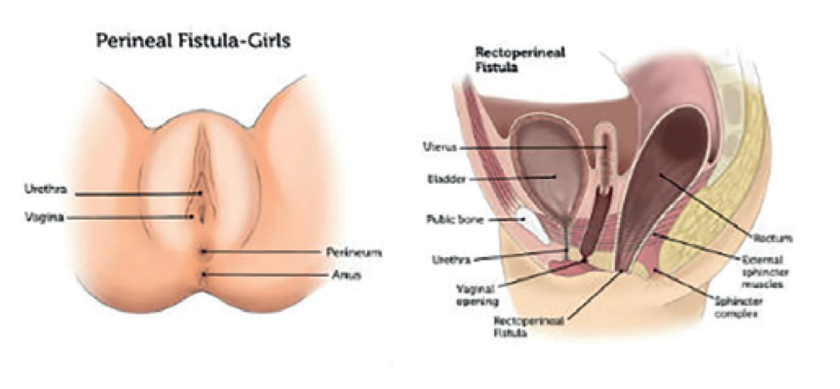 Anus perinei ventralis u dívek
(dostupné z https://www.childrenshospital.org/conditions-
-and-treatments/conditions/a/anorectal-malformation)<br>
Fig. 1: Anus perinei ventralis in girl
(available at https://www.childrenshospital.org/conditions-
-and-treatments/conditions/a/anorectal-malformation)
