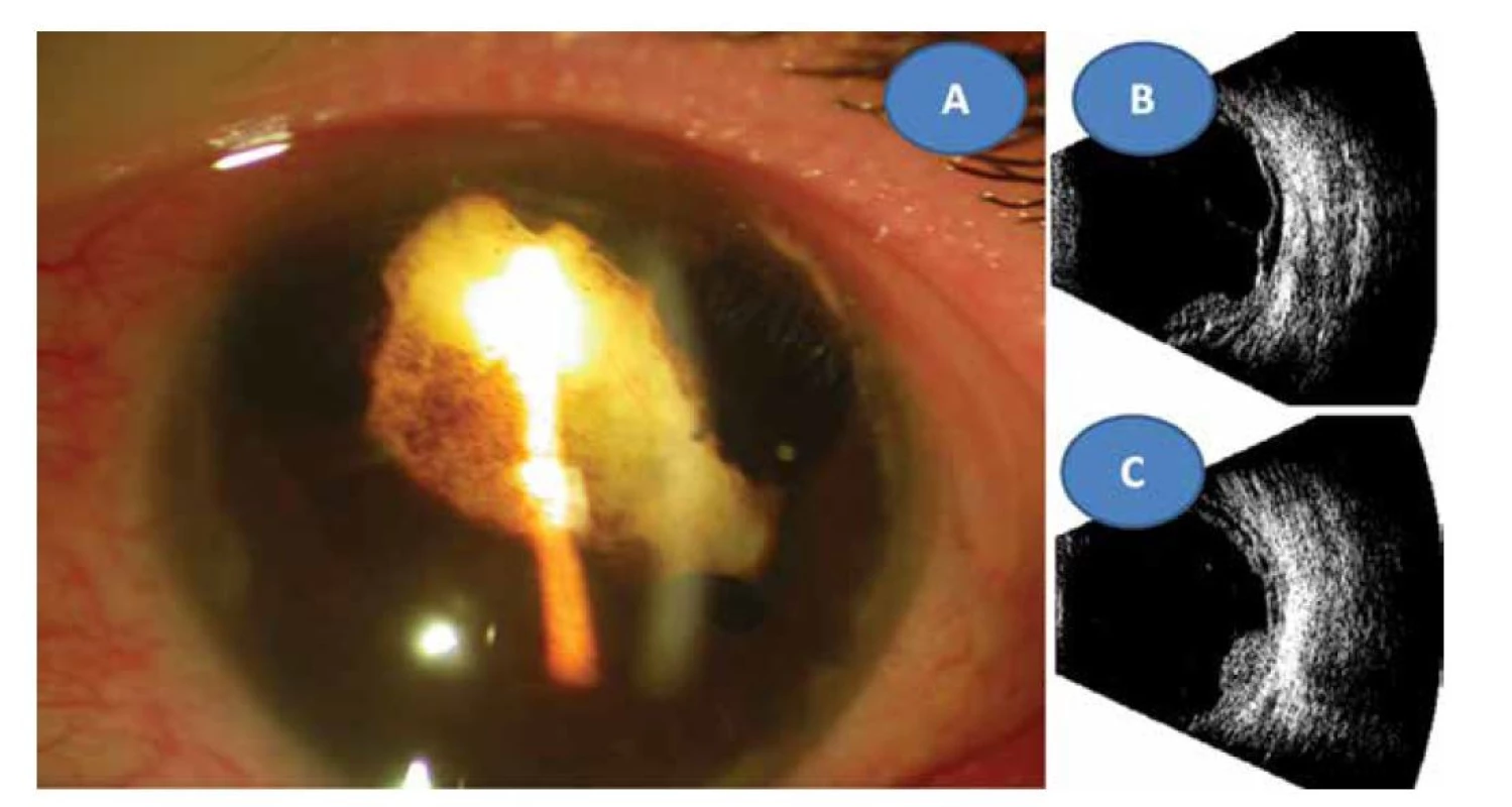 Reduková totální katarakta se sekluzí zornice ve 22 letech (A) ultrazvukový obraz totální amoce (B) a granulom
sítnice 2,9 x 9,6 mm (C)