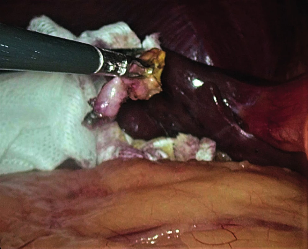 Extirpated organ at the end of the laparoscopic
cholecystectomy