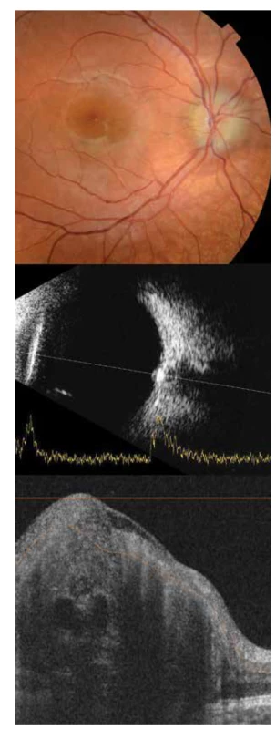 Foto očního pozadí pravého oka 8letého pacienta
zobrazuje pseudoedém predominantně temporálně. Sonograficky
hyperechogenita v oblasti papily zrakového nervu pravého
oka, na swept source OCT skenu viditelné drobné mnohočetné
drúzy jako ostře ohraničená hyporeflektivní ovoidní ložiska.
Na OCT skenu jsou dále patrné cévy, které jsou hyporeflektivní
s charakteristickým stínem